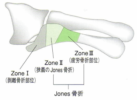 Jones骨折分類