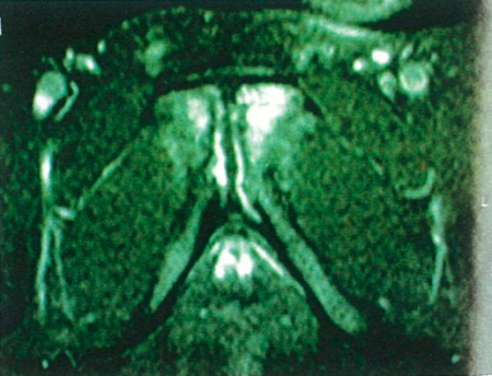 恥骨炎MRI