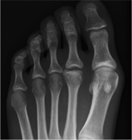 MTP関節の痛みの原因となる足の外科疾患のフライバーグ（Freiberg）病