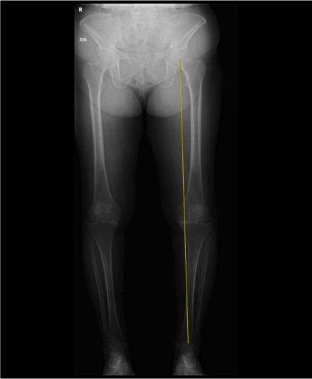 変形性膝関節症　下肢全長　レントゲン