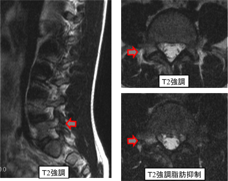 症例2　MRI像