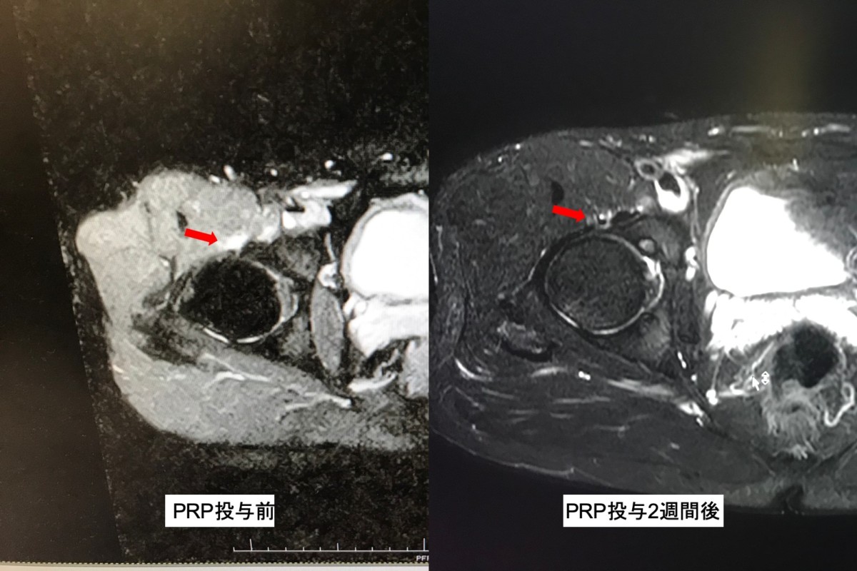 肉離れに対するprpの効果は ブログ主の腸腰筋肉離れに対する効果を画像付きで紹介 目指せスポーツドクター目指せスポーツドクター