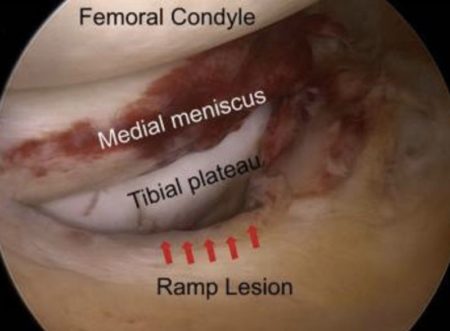 Acl損傷と関連が強い半月板のramp Lesion ランプ病変 とは 目指せスポーツドクター目指せスポーツドクター